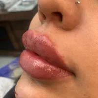 تزریق ژل لبm مادلینگmd codeلیزر بوتاکس کلینیک پوست|خدمات آرایشگری و زیبایی|تهران, ستارخان|دیوار
