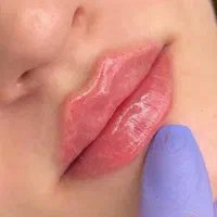 تزریق ژل لب روسی آنزیم زاویه سازی لیزر توسط پزشک|خدمات آرایشگری و زیبایی|تهران, صادقیه|دیوار