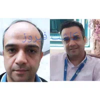 کاشت مو فول تراکم|خدمات آرایشگری و زیبایی|تهران, نارمک|دیوار