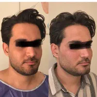 تزریق چربی صورت دست با سن بیکینی در کلینیک تخصصی|خدمات آرایشگری و زیبایی|تهران, صادقیه|دیوار