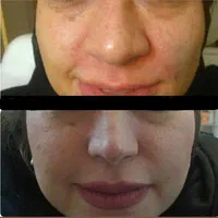 آنزیم ژل لب.بینی.غعبغب. ژل های گلوله شده چربی سوز|خدمات آرایشگری و زیبایی|خرم‌آباد, |دیوار