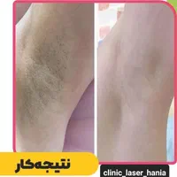 جشنواره بهاری لیزر موی زائد فول ۴۲۰ به مدت محدود|خدمات آرایشگری و زیبایی|ارومیه, |دیوار