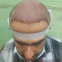 کاشت مو|خدمات آرایشگری و زیبایی|شیراز, قصرالدشت|دیوار