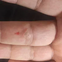 زگیل تناسلی|خدمات آرایشگری و زیبایی|تبریز, |دیوار