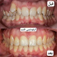 دندانپزشکی ایمپلنت کامپوزیت ارتودنسی لمینت روکش|خدمات آرایشگری و زیبایی|تبریز, |دیوار