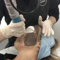 لیزر کیوسوئیچ رفع تیرگی صورت بیکینی و ریمو تاتو