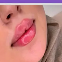 تزریق فیلر ژل بوتاکس هایفو فشیال لیزرکاملا اقساطی