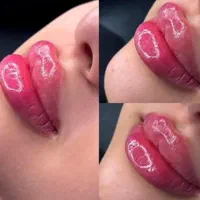 ژل لب چانه گونه بوتاکس فیلرآنزیم بینی لیزرهایفو|خدمات آرایشگری و زیبایی|مشهد, سجاد شهر|دیوار