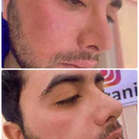 ژل بوتاکس فیلر مزوتراپی پیرسینگ و آموزش حرفه ایی|خدمات آرایشگری و زیبایی|قم, هنرستان|دیوار