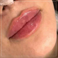 تزریق ژل و بوتاکس تخفیف  عیدانه۳۹۹|خدمات آرایشگری و زیبایی|تهران, عبدل‌آباد|دیوار