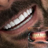کامپوزیت دندانها تخفیف تابستان|خدمات آرایشگری و زیبایی|اهواز, کیان اباد|دیوار