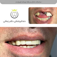 ایمپلنت دیجیتال با اقساط بلند مدت|خدمات آرایشگری و زیبایی|تهران, امیریه|دیوار