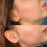 تخفیف ویژه ژل و بوتاکس کاشت نخ  لیفت و اموزش