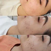 درمان مشکلات پوست مطب/مزوتراپی/فشیال/مزونیدلینگ/ژل|خدمات آرایشگری و زیبایی|مشهد, دانشجو|دیوار