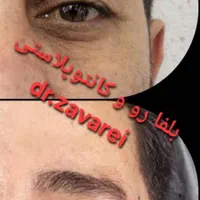 بلفاروپلاستی پلک فوقانی  بالیزر|خدمات آرایشگری و زیبایی|تهران, شهرک غرب|دیوار