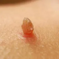 زگیل تناسلیhpv/میخچه/زیگیل/خال/بواسیر هموروئید|خدمات آرایشگری و زیبایی|تهران, دانشگاه علم و صنعت|دیوار