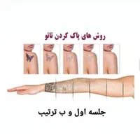 پاک کردن تتو با لیزر (کیوسوییچ)و کربن تراپی