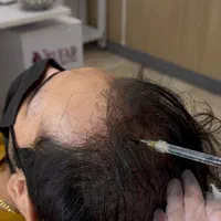 فشیال مزوتراپی مو‌ هیرفیلر پی ار پی prp مزونیدلینگ|خدمات آرایشگری و زیبایی|کرج, مهرویلا جنوبی|دیوار