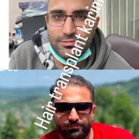 کاشت مو ابرو ریش|خدمات آرایشگری و زیبایی|تهران, جماران (نیاوران)|دیوار