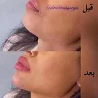 کلینیک تزریق ژل و بوتاکس انزیم پزشک|خدمات آرایشگری و زیبایی|کرج, گوهردشت|دیوار