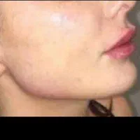 تزیق فیلروبوتاکس لیزر موهای زائد هایفو خالبرداری|خدمات آرایشگری و زیبایی|بوشهر, |دیوار