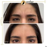 ژل لب روسی/بوتاکس/فیلر زیر چشم/زاویه فک لیزر بدن|خدمات آرایشگری و زیبایی|تهران, ستارخان|دیوار