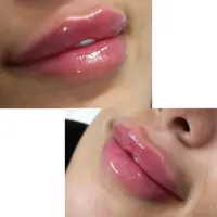 تزریق ژل لب و بوتاکس(پک 10cc)،جوانسازی و فیشال|خدمات آرایشگری و زیبایی|تهران, مهران (سیدخندان)|دیوار