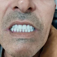 دندانسازی، دندان سازی، دندان مصنوعی، تعمیر شکستگی|خدمات آرایشگری و زیبایی|مشهد, یوسفیه|دیوار