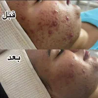 خدمات لیزر و فیشال و زیبایی