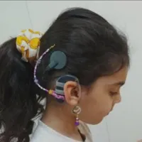 دستگاه شنوایی کاشت حلزون گمشده