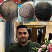 خدمات زیبایی کاشت مو|خدمات آرایشگری و زیبایی|یاسوج, |دیوار