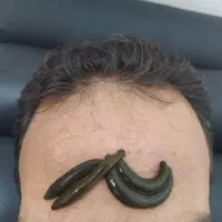 حجامت،طب سوزنی،اصلاح ستون فقرات