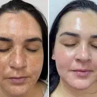 (کلینیک دنا) مزو صورت و بدن تظمینی