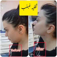 جشنواره ساکشن تخصصی غبغب و تزریق چربی اقساط|خدمات آرایشگری و زیبایی|تهران, شهر زیبا|دیوار