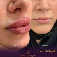 جشنواره50%کلینیک تزریق ژل بوتاکس پروفایلو لیزر
