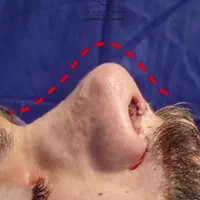 جراحی بینی ابدو،چربی لیپو 360ترانسفر باسن بیکینی|خدمات آرایشگری و زیبایی|اندیشه, اندیشه فاز ۱|دیوار