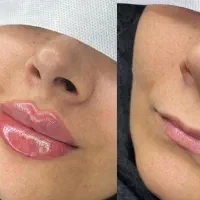 اف ژل لب وآف بوتاکس درمطب پزشک|خدمات آرایشگری و زیبایی|مشهد, احمدآباد|دیوار