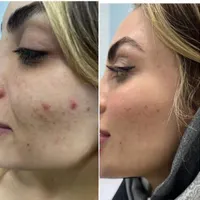 تخفیف بوتاکس، فیلر، بلفاروپلاستی، لاغری و فیشال|خدمات آرایشگری و زیبایی|تهران, ظفر|دیوار