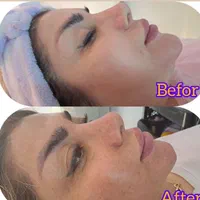 خدمات پاکسازی پوست،میکرونیدیلینگ، پلکسرواسیدتراپی|خدمات آرایشگری و زیبایی|کرج, گوهردشت|دیوار