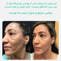 پیلینگ هالیوودی صورت و سفید کننده بیکینی|خدمات آرایشگری و زیبایی|کرج, گوهردشت|دیوار