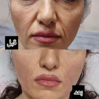 هایفوتراپی جوانسازی لیفت صورت غبغب آف به مدت محدود|خدمات آرایشگری و زیبایی|قم, شهرک قدس|دیوار