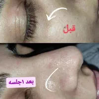 پاکسازی و فشیال پوست، اسکالپ کف سر، آموزش صفرتاصد|خدمات آرایشگری و زیبایی|قزوین, |دیوار