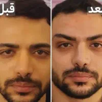لیفت تخصصی صورت بانخ ،فرمدهی بینی ،لیفت ابرو شقیقه|خدمات آرایشگری و زیبایی|مشهد, احمدآباد|دیوار