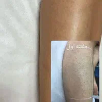 لیزر جدیدترین تیتانیوم۲۰۲۵باضمانت نامه۵۰درصد تخفیف|خدمات آرایشگری و زیبایی|بندرعباس, |دیوار