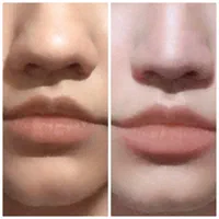 کلینیک ژل آنزیم بینی. لب بوتاکس فیلر و آموزش|خدمات آرایشگری و زیبایی|مشهد, آزادشهر|دیوار