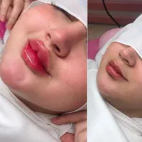 جشنواره بهاره ژل و بوتاکس آنزیم لیزر مزوتوسط پزشک|خدمات آرایشگری و زیبایی|کرج, جهان‌شهر|دیوار