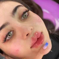 فیلر چانه گونه کانتورینگ زاویه ژل لب بوتاکس شیدینگ|خدمات آرایشگری و زیبایی|فردیس, |دیوار