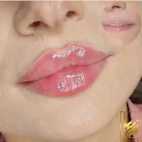 تزریق فیلر زیر چشم ژل لب روسیm کلینیک تخصصی لیفت|خدمات آرایشگری و زیبایی|تهران, صادقیه|دیوار