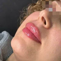 جشنواره ویژه بوتاکس و ژل