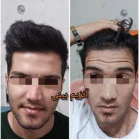 تزریق آنزیم بینی/فیلر بینی/شقیقه/ژل/درکلینیک پزشکی|خدمات آرایشگری و زیبایی|شیراز, زرهی|دیوار